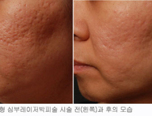 난치성 여드름 흉터 ‘한국형 심부레이저박피술’ 효과 톡톡