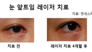 눈엣가시 '눈매교정 앞트임 흉터' 레이저 치료로 말끔