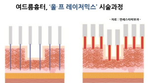 골칫거리 여드름흉터, 치료법은?