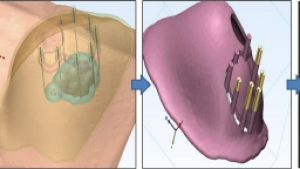 유방 절제 부위 3D 모형따라 과도한 절제 줄여