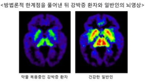 강박증 증상 호전되어도 약물치료 중단 말아야