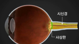 황반변성을 아십니까…젊은층도 예외없다