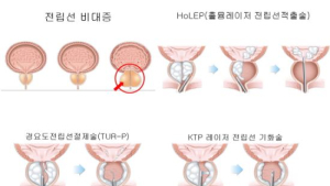 오승준 교수 “전립선비대증 환자 레이저 홀렙수술 만족”