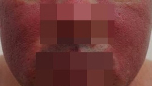 지루성피부염 치료, ‘독소’ 제거가 ‘첫걸음’