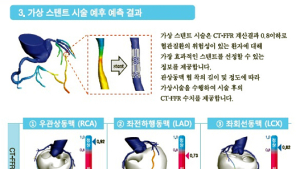 고통없이 저렴하게 협심증, 심근경색 예측
