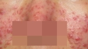 지긋지긋 따라다니는 지루성피부염 극복방법은?