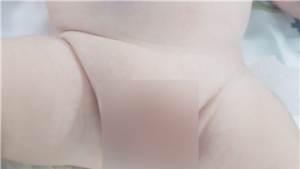 내 아이의 사타구니가 불룩…'소아 서혜부 탈장'일까?