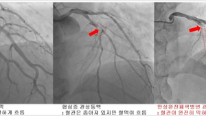 가슴 답답 ‘협심증’ 환자가 늘고 있다… 놔두면 심근경색·사망으로