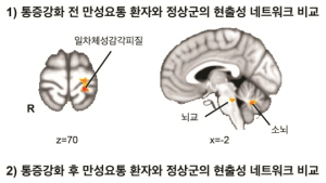 한의학연, 정상인과 만성 요통 환자 ‘뇌 신경망’ 차이 밝혀