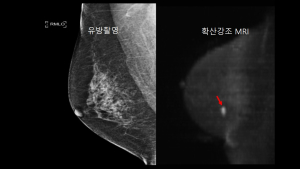조영제 없이 숨어있는 유방암 찾아낸다 