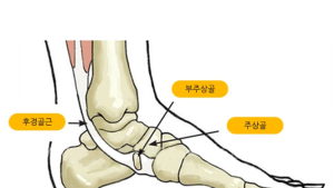 자녀의 복사뼈 아래 부위가 심하게 부어 있으면 ‘부주상골증후군’ 의심