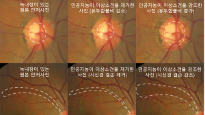 서울대병원, 녹내장 진단하는 인공지능 개발 