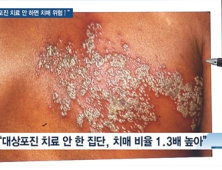 [쿠키건강뉴스] “대상포진 치료 안 하면 치매 발생 위험 커져”