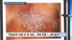 [쿠키건강뉴스] “대상포진 치료 안 하면 치매 발생 위험 커져”