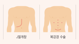 20대 딸이 어머니에 간 기증...