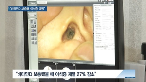 [쿠키건강뉴스] “부족한 비타민D 보충하면 이석증 예방 가능”