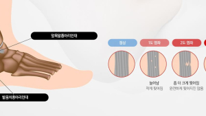 갑자기 ‘발목’이…30대인데 관절염이라고