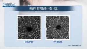 [쿠키건강뉴스] “근시로 안구길이 늘어나면 망막병증 위험 커져”