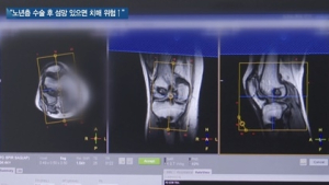 [쿠키건강뉴스] “노년층 수술 후 섬망 있으면 치매 위험 급증”