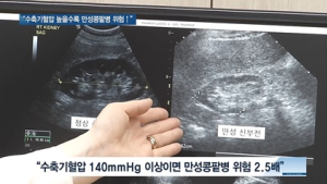 [쿠키건강뉴스] “수축기혈압 높을수록 만성콩팥병 발생 위험 커져”