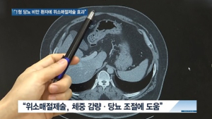 [쿠키건강뉴스] “1형 당뇨 고도비만 환자에 위소매절제술 효과적”