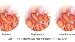 안전·유효성 확인됐는데...예비급여만 5년째 타비시술 이유는?