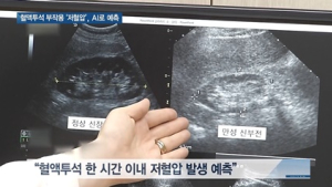 [쿠키건강뉴스] 혈액투석 부작용 ‘저혈압’…인공지능으로 예측