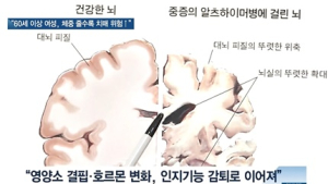 [쿠키건강뉴스] “60세 이상 여성, 체중 감소 클수록 치매 위험 높아”