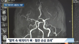[쿠키건강뉴스] “뼈 약해지면 뇌혈관 위험”…뇌졸중 환자 61%, 골밀도 저하