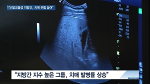 [쿠키건강뉴스] “비알코올성 지방간, 노년기 치매 위험 높여”