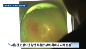 [쿠키건강뉴스] “당뇨망막병증으로 인한 시력 저하 원인 규명”