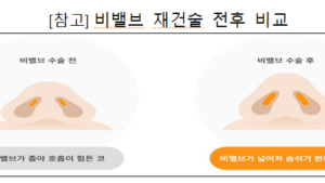 금감원 “하지정맥류·쌍꺼풀 수술, ‘질병치료 목적’만 실손보험 보장”