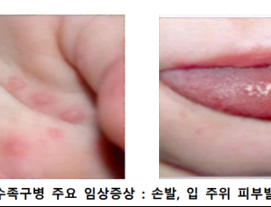 영유아 수족구병 확산…최근 10년 새 가장 큰 유행