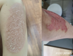 미충족 의료 수요 높은 ‘건선’…“치료제 급여 정보 부족”