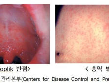 홍역 환자 5년 만에 최다…“여행 전 백신 접종 받아야”