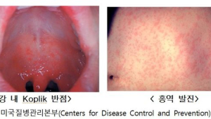 홍역 환자 5년 만에 최다…“여행 전 백신 접종 받아야”
