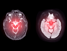 파킨슨병 조기 진단하는 ‘AI 기술’ 개발…“판별 정확도 99.7%”